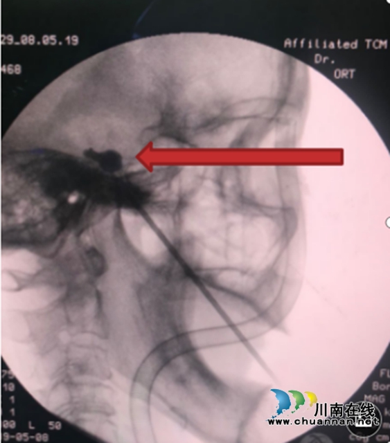 大妈被拔光牙齿，没想到得的是三叉神经痛！