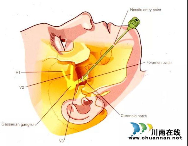 大妈被拔光牙齿，没想到得的是三叉神经痛！(图3)
