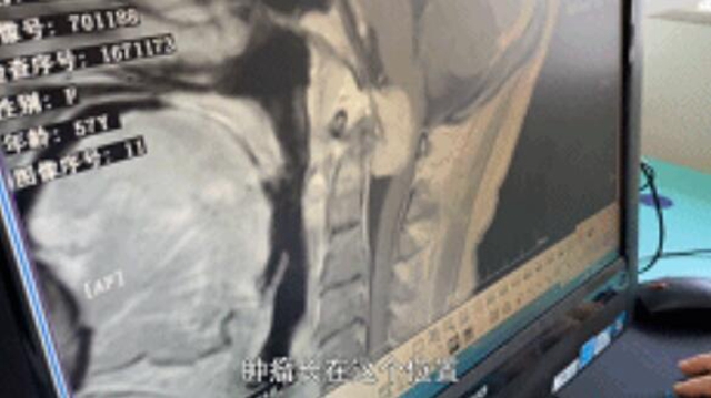 开始只是手指发麻,一查竟是颅内肿瘤!差点就瘫痪……(图3) 开始只是手指发麻,一查竟是颅内肿瘤!差点就瘫痪……(图3)