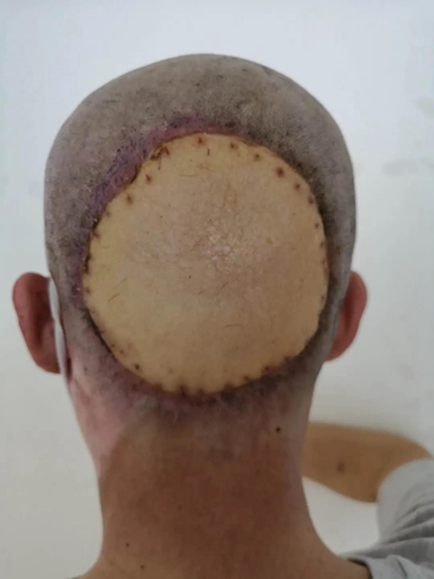 【关注】男子被10万伏高压电烧焦？(图5)