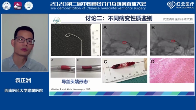 西南医大附院脑卒中团队袁正洲博士再次斩获全国冠军!(图3) 西南医大附院脑卒中团队袁正洲博士再次斩获全国冠军!(图3)