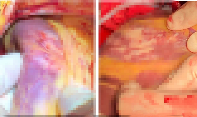 【关注】10小时!心胸外科专家再战极限?(图9) 【关注】10小时!心胸外科专家再战极限?(图9)