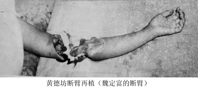53年前，央广向全世界播发：泸州医专附院为14岁少年成功接上断臂！(图4)