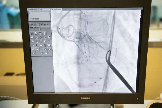 不开胸换心脏主动脉瓣新技术带来新希望(图3)