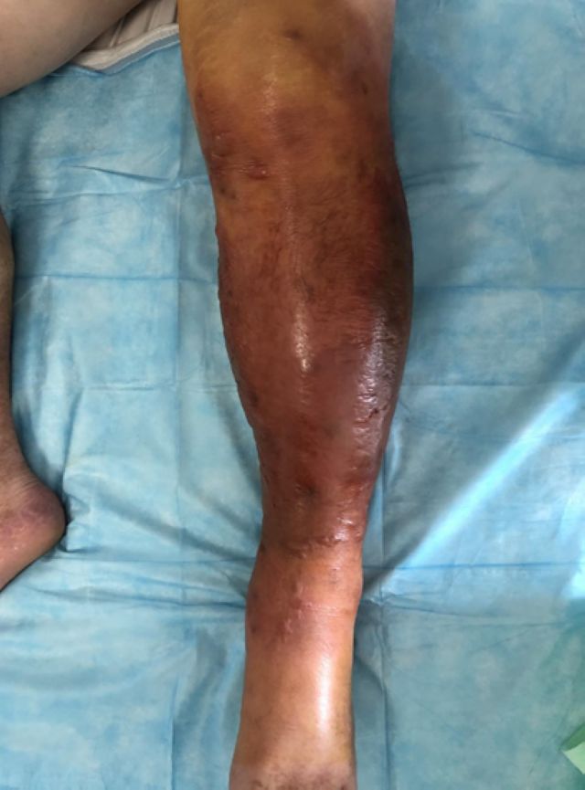 【围观】小腿肿成巨型“红萝卜”，泸州男子中了什么毒？