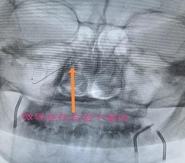 跻身国内先进水平！西南医大附院库欣病诊断技术获突破(图6)