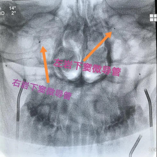跻身国内先进水平！西南医大附院库欣病诊断技术获突破(图4)