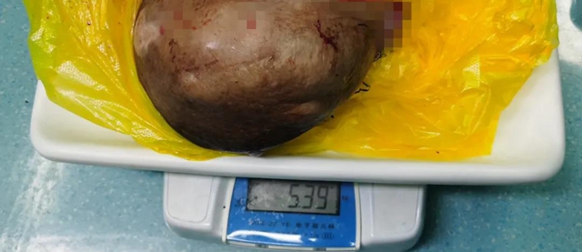 【关注】女子乳房长出巨大肿瘤，重达10斤？(图5)
