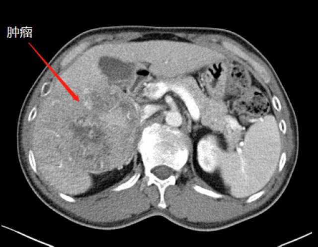 泸州首例ALPPS！泸州市中医医院根治晚期肝癌有全新突破(图2)