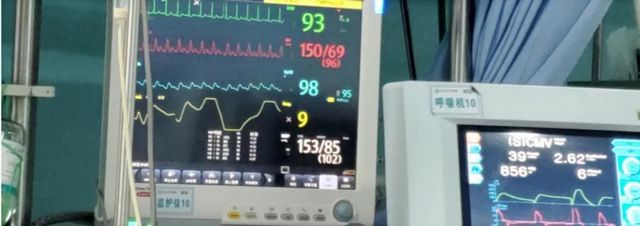 首例！救命的硬核武器—ECMO技术在西南医大附院成功开展(图7)