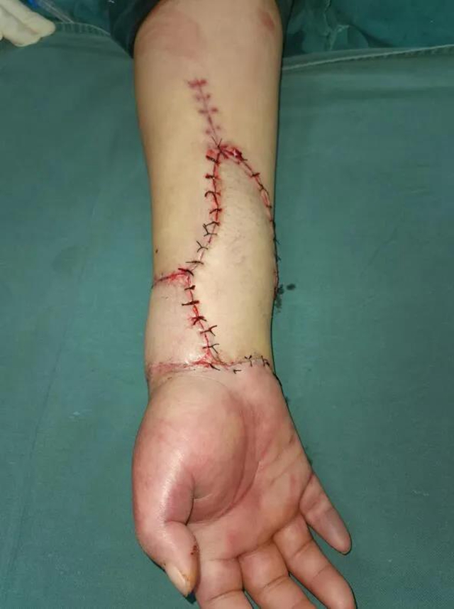 【意外】泸州男子右手被搅拌机连“根”拔起！(图4)