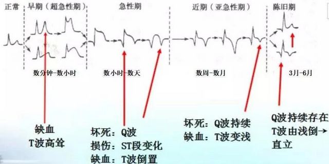 你的心脏在求救！急性心梗的这些预警信号， 你知道吗？(图9)