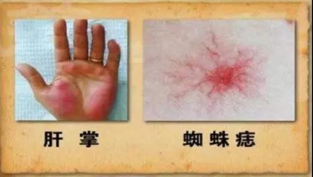【关注】吴孟达患肝癌去世！这些信号要警惕？(图8)