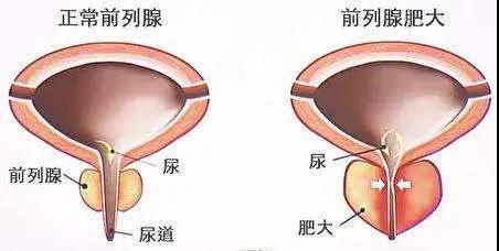 【扩散】男性专属，一旦发现，大部分已是晚期？(图2)