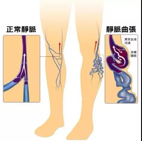 【围观】泸州女教师小腿酸痛1个月，一双美腿险些毁掉(图5)