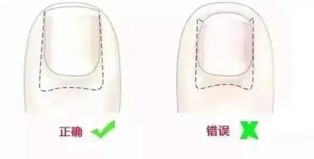 【扩散】脚指甲剪很短，感觉很爽？！代价却很……(图5)