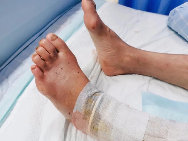 【围观】毒蛇频繁出没！泸州8人被咬伤入院……(图6)