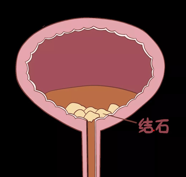 泸州:87岁大爷身体里掏出3斤石头(图4) 泸州:87岁大爷身体里掏出3斤石头(图4)