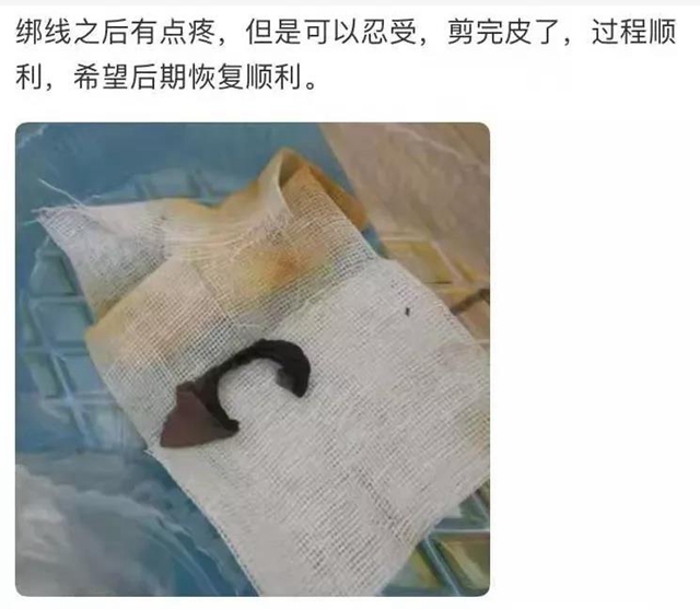 【围观】真猛！男子竟自己割包皮？(图1)