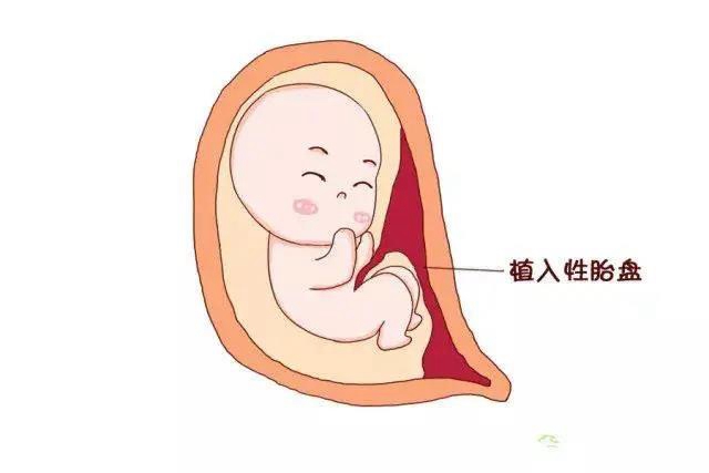 【凶险】胎盘完全堵住宫口，二胎妈妈差点送命？(图4)