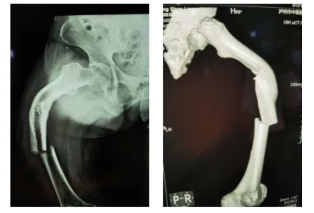 妈妈意外摔断腿，女儿却说“因祸得福”？(图1)