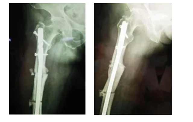 妈妈意外摔断腿，女儿却说“因祸得福”？(图3)