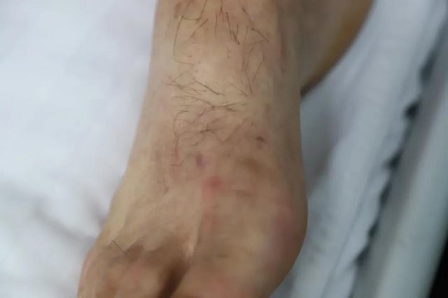 【扩散】致命“红火蚁”出没，泸州男子被咬伤入院(图2)