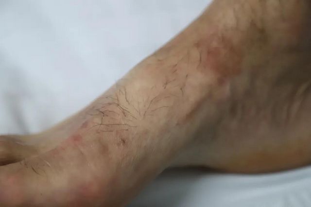 【扩散】致命“红火蚁”出没，泸州男子被咬伤入院(图6)