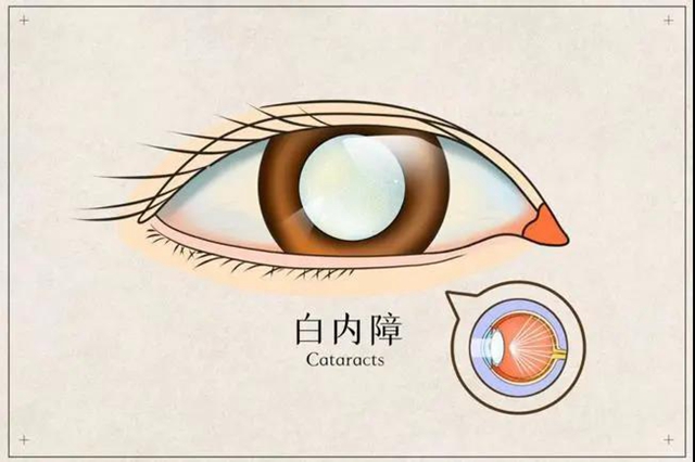 【提醒】躲不过的白内障，究竟何时做才最有效？(图1)