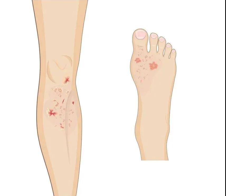 【警惕】湿疹为何反复发作?(图3) 【警惕】湿疹为何反复发作?(图3)