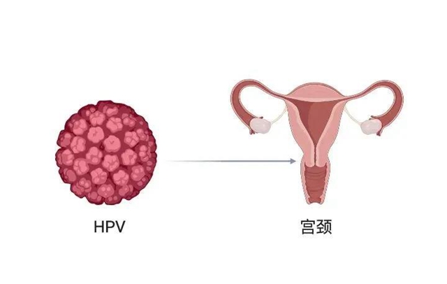 【扩散】感染了HPV病毒，就是得了宫颈癌？