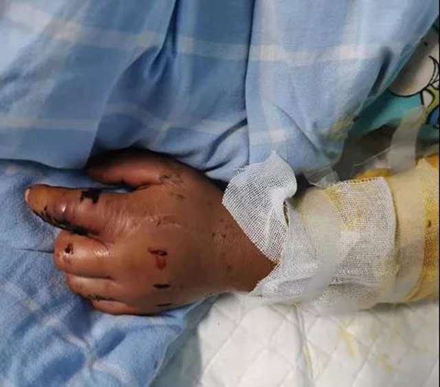 毒蛇还不冬眠？泸州4岁男孩被咬伤入院……(图2)