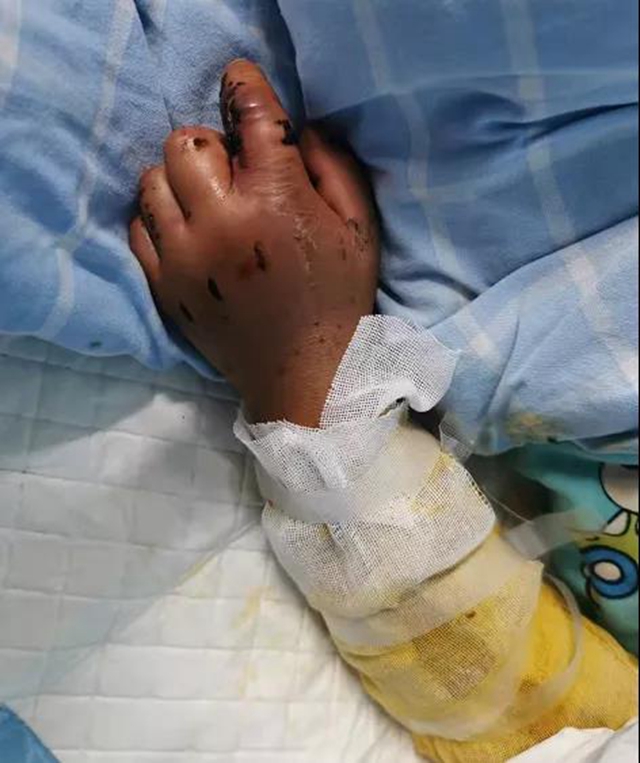 毒蛇还不冬眠？泸州4岁男孩被咬伤入院……(图3)