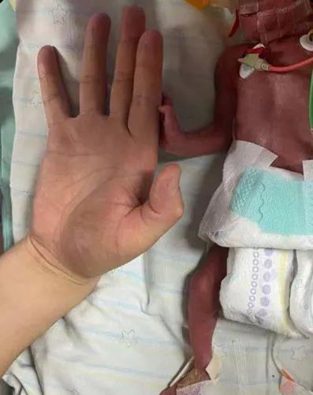 【围观】出生时仅2斤，又一“巴掌宝宝”闯关成功(图1)