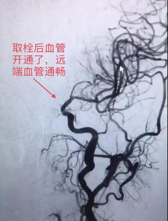 转发可以救命!中风急救,抓住黄金4.5小时(图4) 转发可以救命!中风急救,抓住黄金4.5小时(图4)