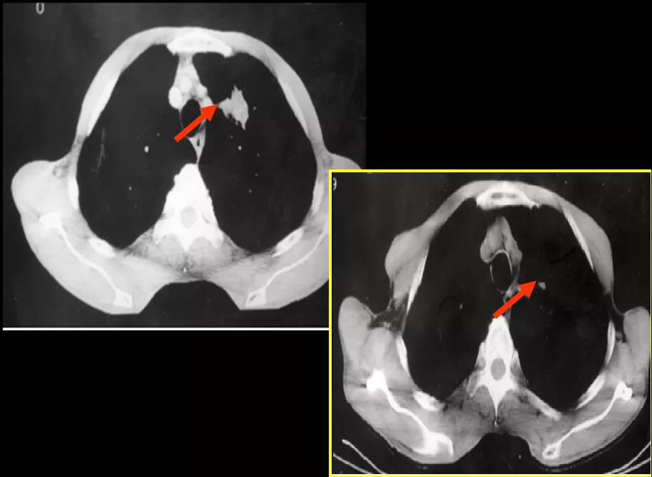 肿瘤变小甚至完全消失！“放疗”到底是个啥？
