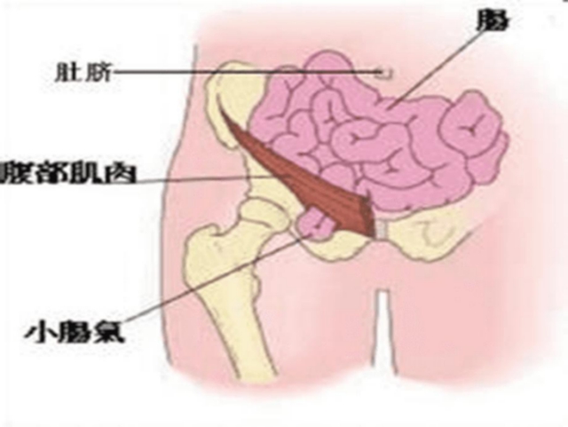 大腿根部卵圆窝解剖图图片