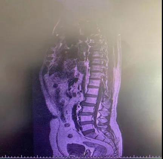 【关注】男子腰痛,医生取出21颗“骨头渣渣”!(图3) 【关注】男子腰痛,医生取出21颗“骨头渣渣”!(图3)