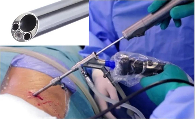 【关注】男子腰痛,医生取出21颗“骨头渣渣”!(图6) 【关注】男子腰痛,医生取出21颗“骨头渣渣”!(图6)