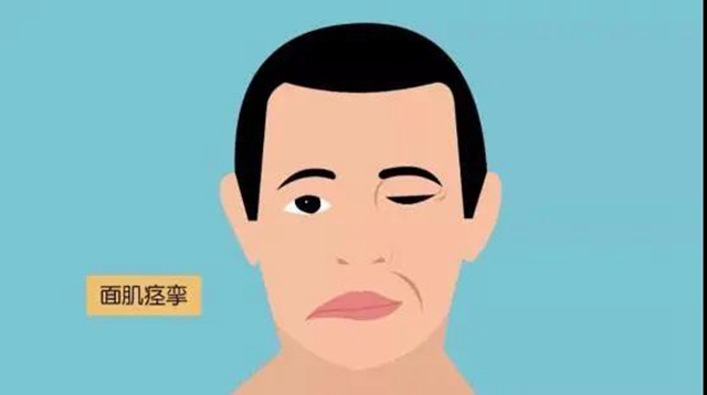 【关注】左眼跳财，右眼跳灾？可能是面痉挛！(图4)