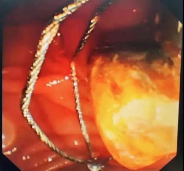 突破极限！泸州市人民医院为2名九旬老人实施ERCP取石术(图2)