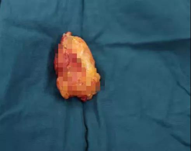 【围观】拿碗端水都很困难，被查出癌？(图5)