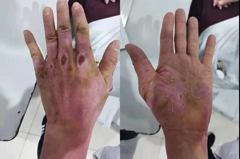 【突发】燃油起火！泸州男子多处被烧伤！(图4)