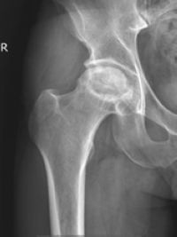 泸州男子每天喝半斤酒,骨头都被泡烂了(图3) 3.jpg