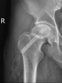 泸州男子每天喝半斤酒,骨头都被泡烂了(图4) 4.jpg