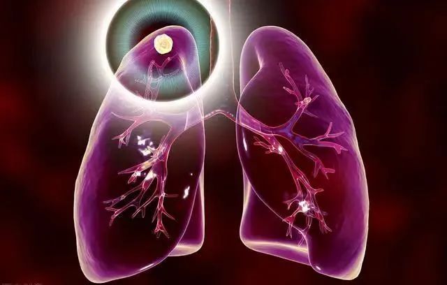 无限纠结的肺结节，这次把两姐妹吓惨了！