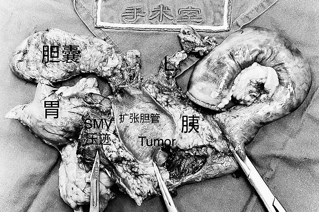 这些症状很常见,一查竟是癌……(图3) nEO_IMG_3.jpg