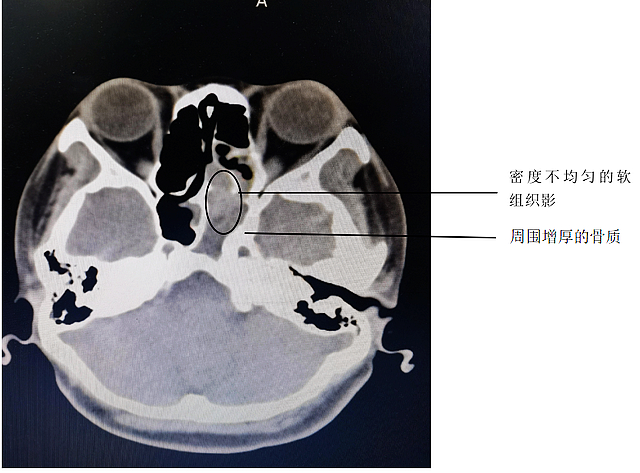 【围观】咳到出血，原来是鼻子出问题了